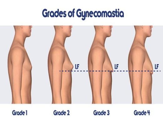 3 Key Factors Men Need to Keep in Mind When Opting for Gynecomastia Surgery