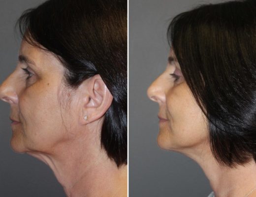 best facelift specialists in Chicagoland