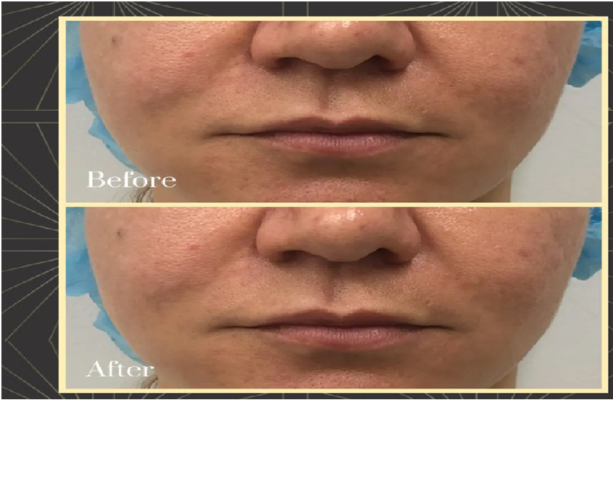 Consider A Thread Lift For A Youthful Appearance
